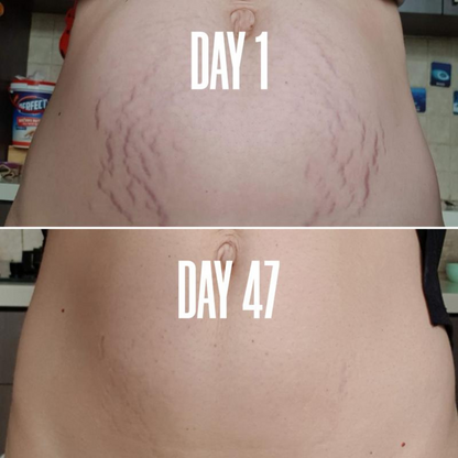 Belly Firming Cream for Stretch Marks